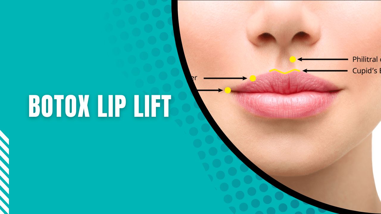 Botox Lip Lift