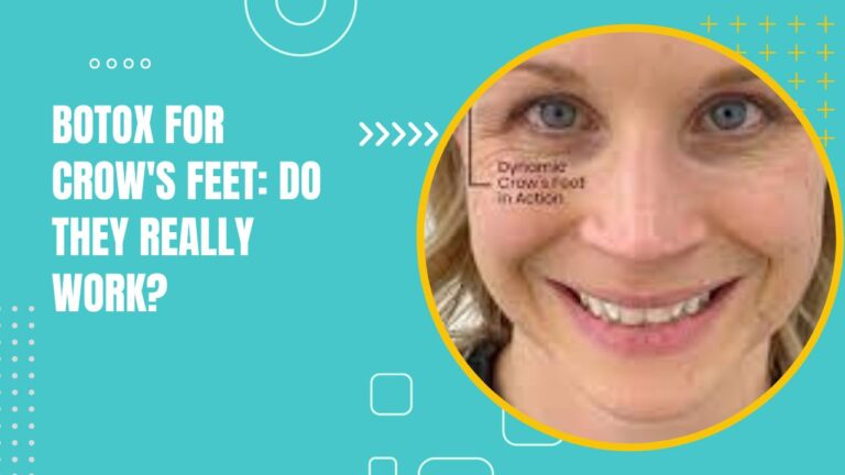 Botox For Crow'S Feet Do They Really Work