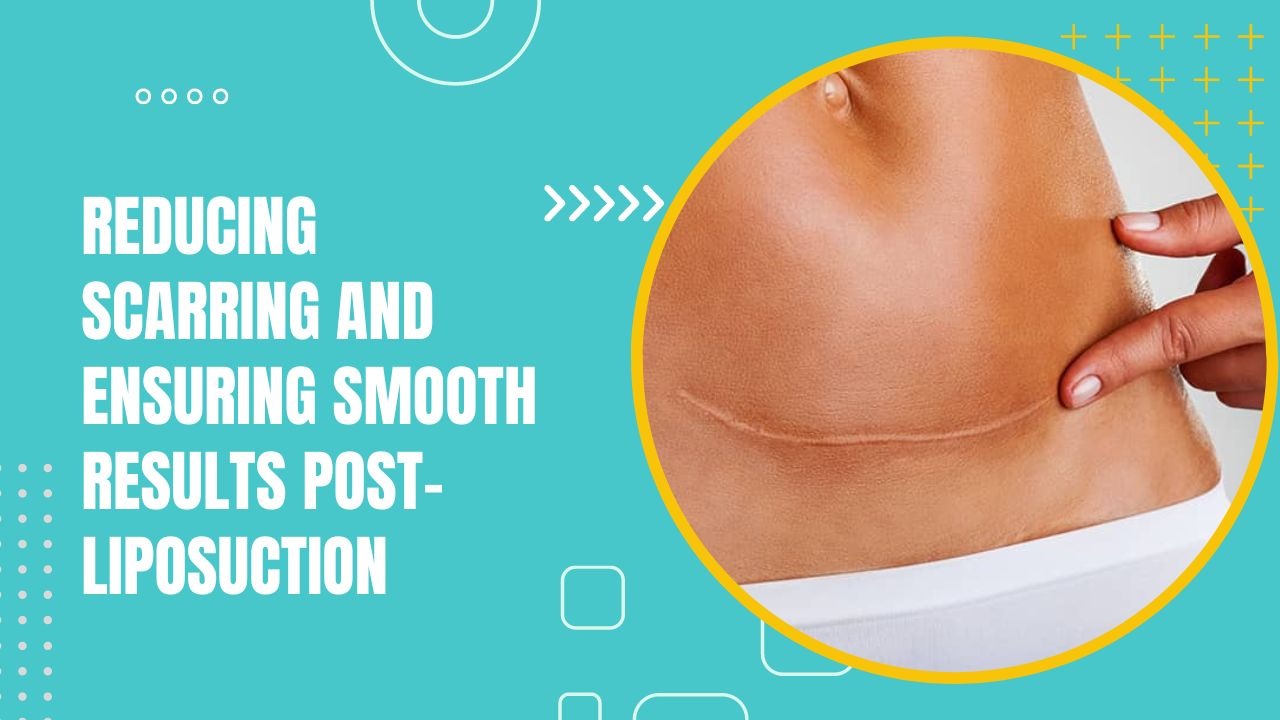 Reducing Scarring And Ensuring Smooth Results Post-Liposuction