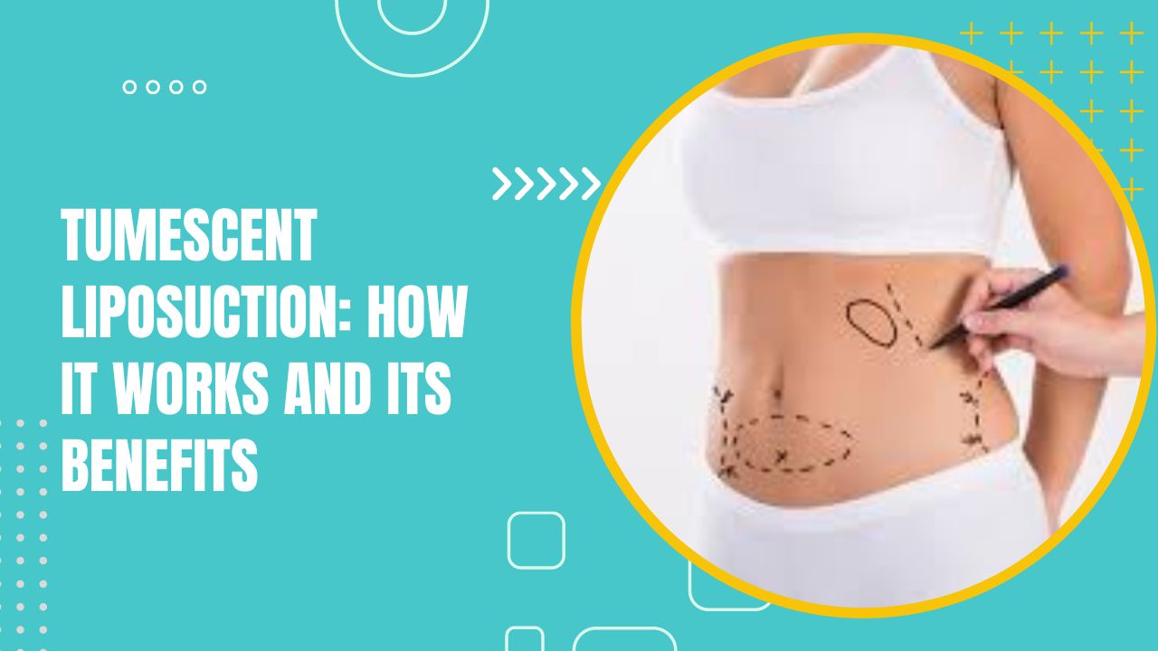 Tumescent Liposuction: How It Works And Its Benefits