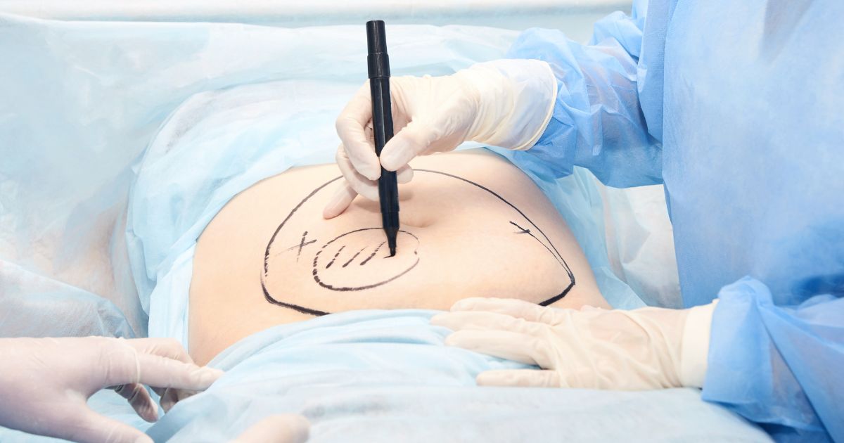 10 Warning Signs Of Liposuction Gone Wrong