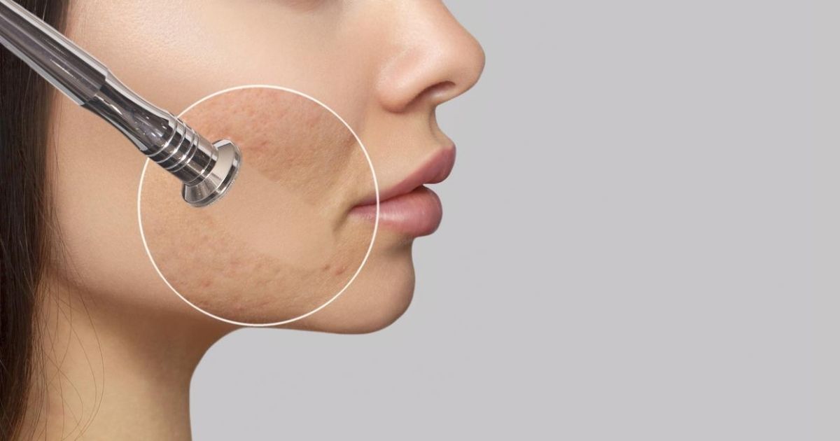 Dermal Fillers As A Solution To Acne Scars