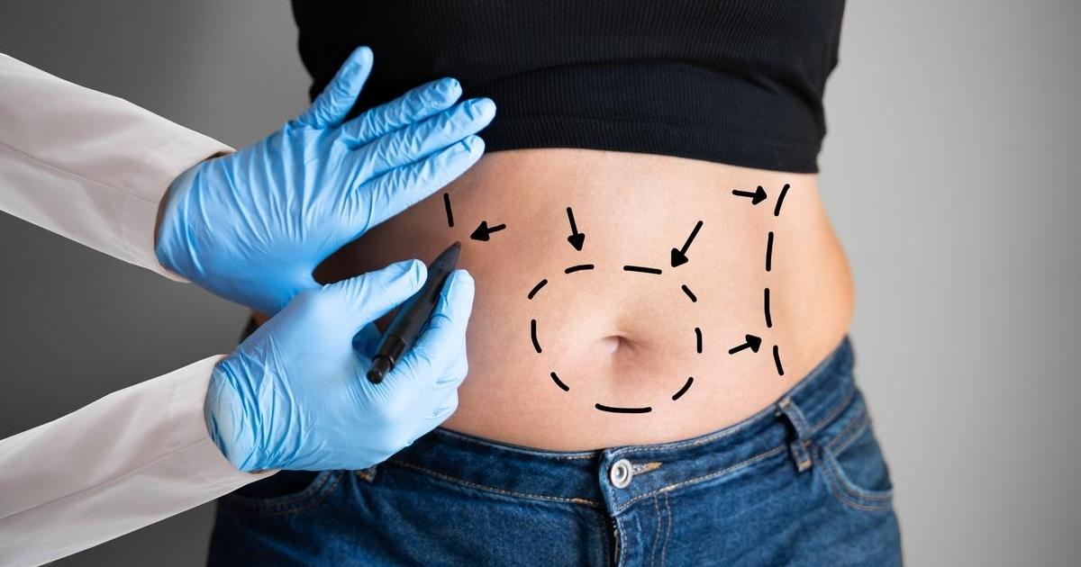 Tummy Tuck In The Elderly