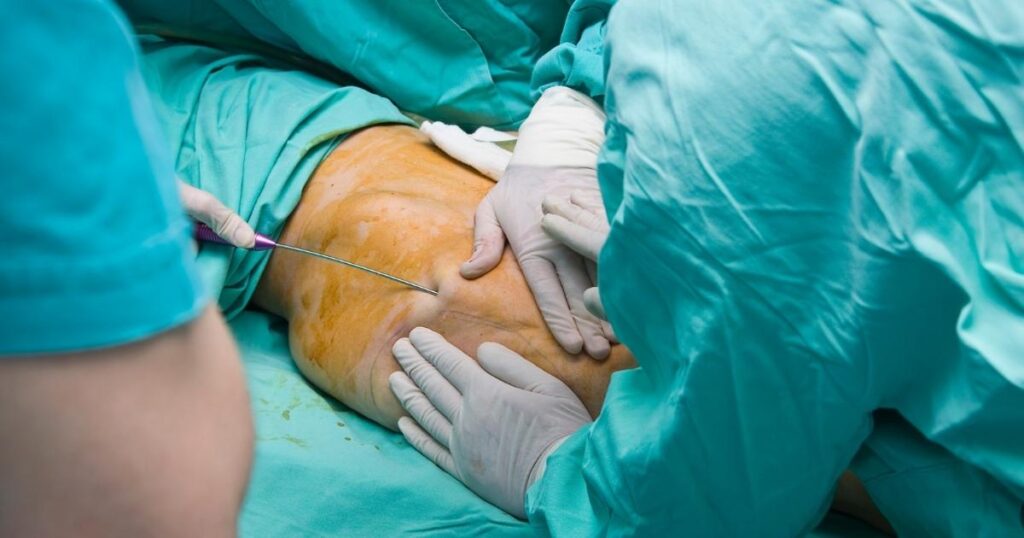 Procedure For Liposuction In Dubai