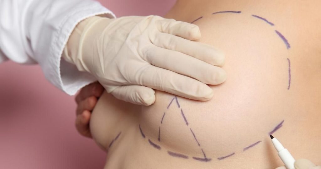 How Long Do Breast Lift Scars Take To Heal?