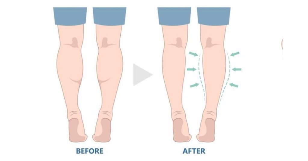 Calves Liposuction Procedure