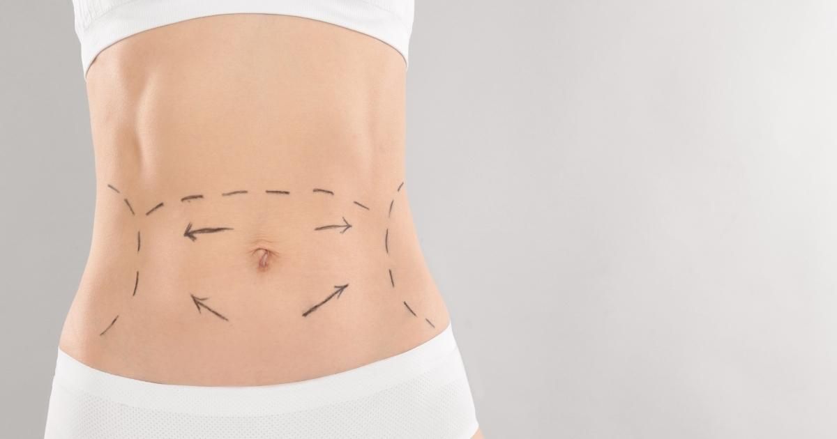 Common Misconceptions About Tummy Tuck Surgery