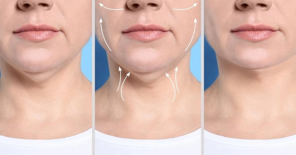  Comparing Results Between Fillers And Fat Transfer