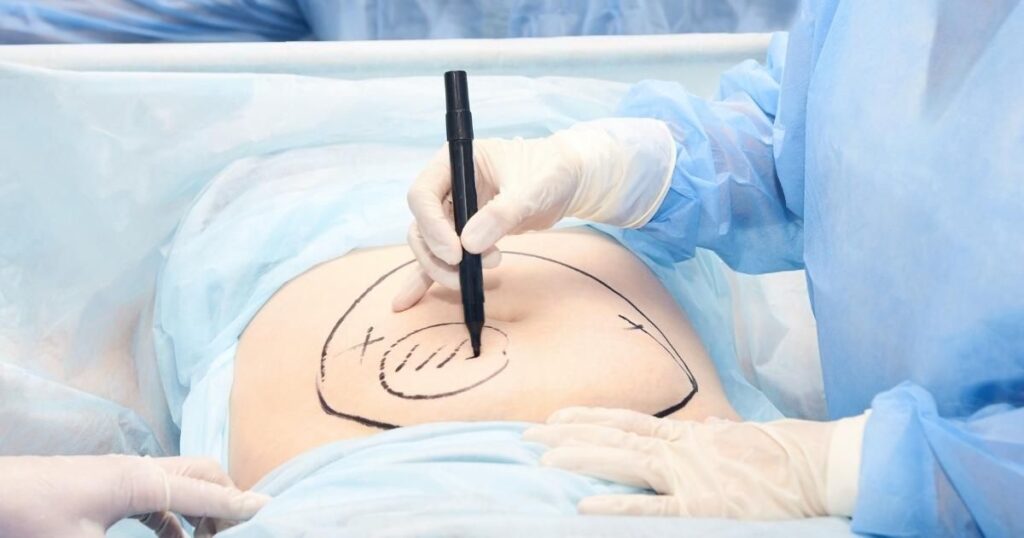 Multiple Sessions Liposuction_ Benefits, Risks And What To Expect