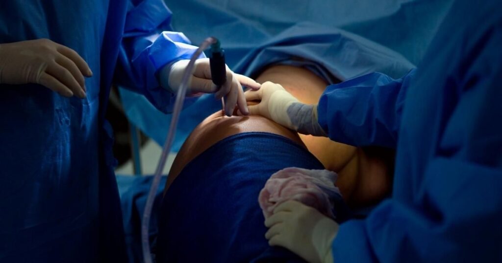 Risks And Potential Complications Of Multiple Sessions Liposuction