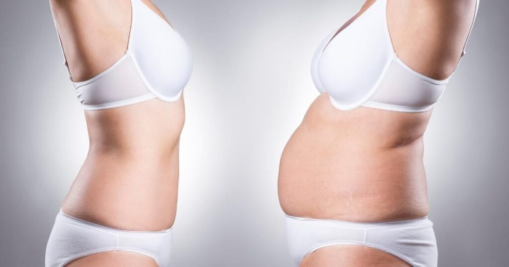 Vaser Liposuction Before And After 