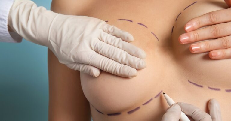 Can You Have A Breast Lift Twice | Breast Lift Revision