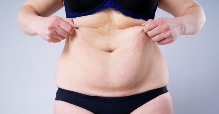 Do You Need A Second Tummy Tuck?