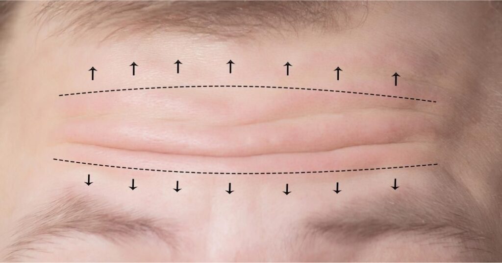 Forehead Lift Surgery In Dubai - Get A Fresh Look