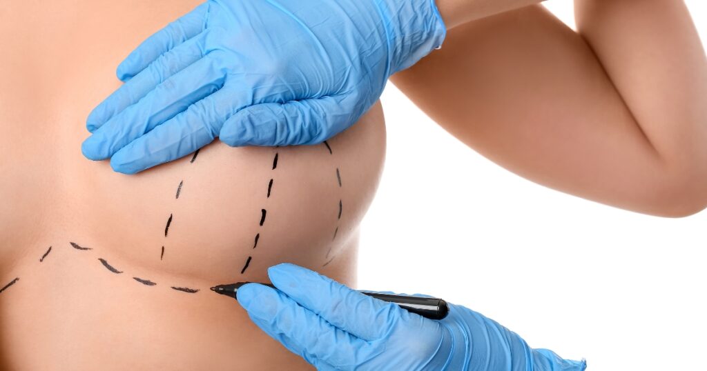 How A Breast Lift Procedure Is Performed