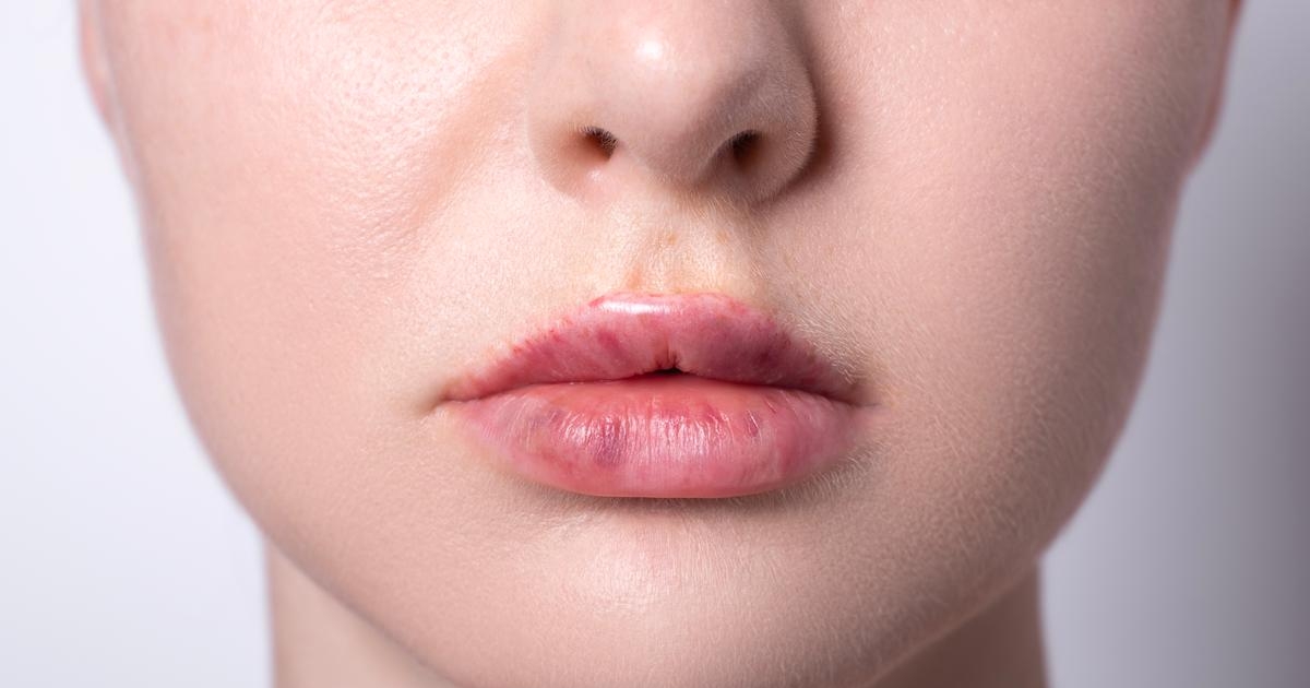 How To Prevent Potential Complications From Fillers