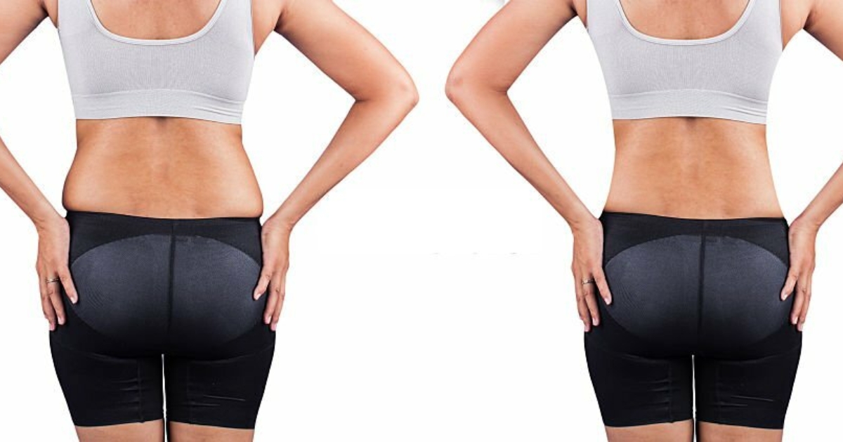 Liposuction Back And Flanks_ Everything You Need To Know