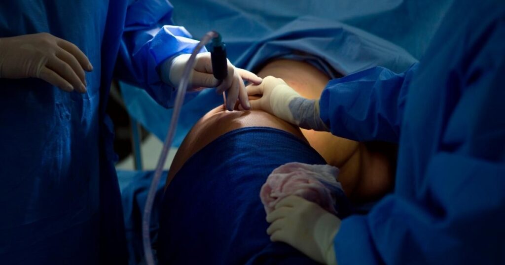 Procedure Details_ How Thigh Liposuction Is Performed