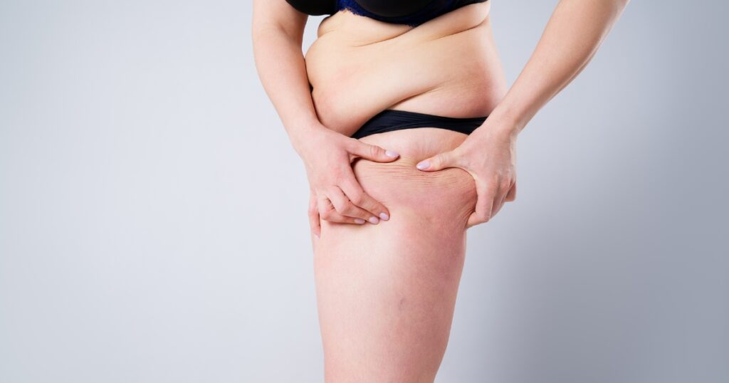 Reasons You Need Thigh Liposuction