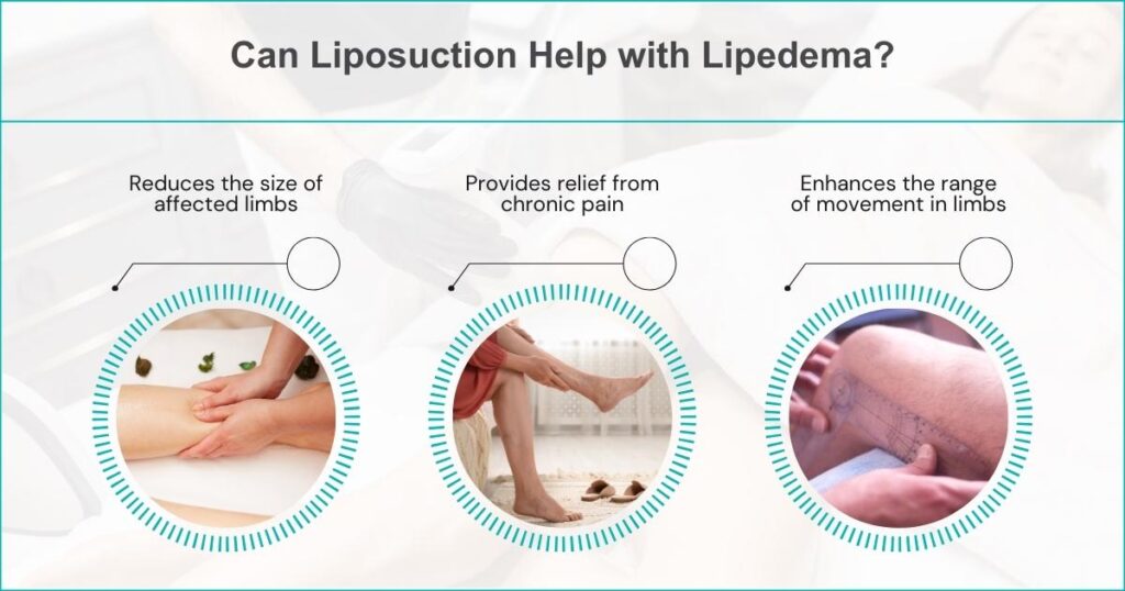 Benefits Of Liposuction For Lipedema