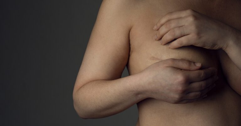 Breast Reduction Scars: What You Need To Know
