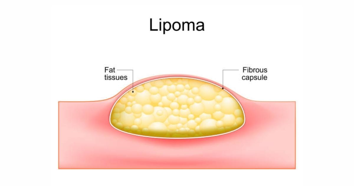 Can Liposuction Treat Medical Conditions Like Lipedema