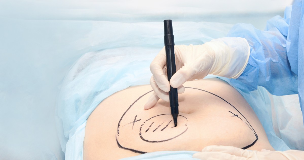 Can Liposuction Treat Medical Conditions