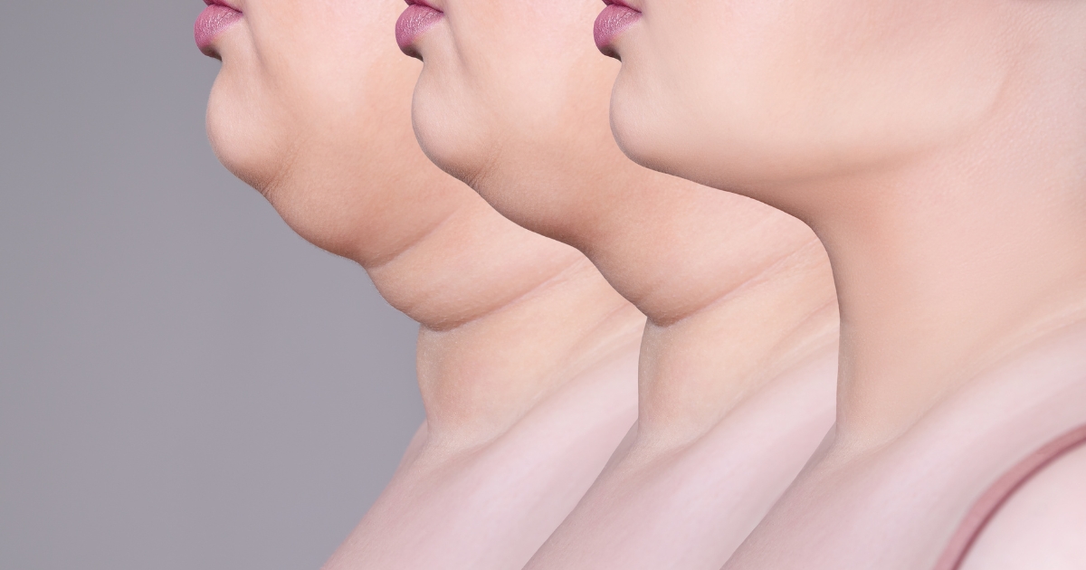 Elevate Elegance With Neck And Chin Liposuction In Dubai