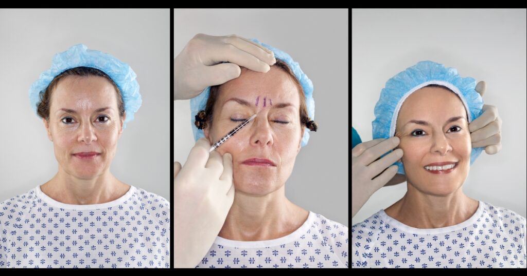 How Long Do Forehead Botox Results Typically Last