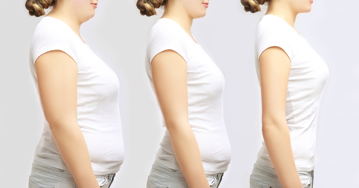 Liposuction And Weight Management