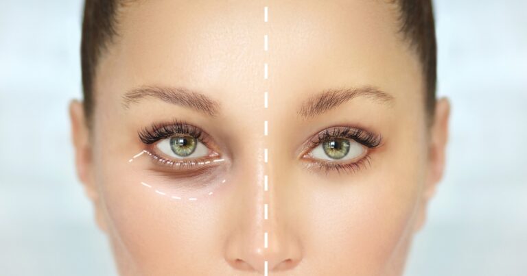 What Is Double Eyelid Surgery? A Detailed Explanation