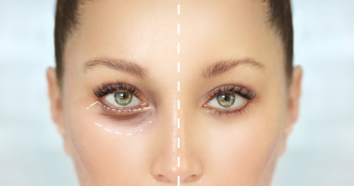 Eyelid Surgery In Dubai