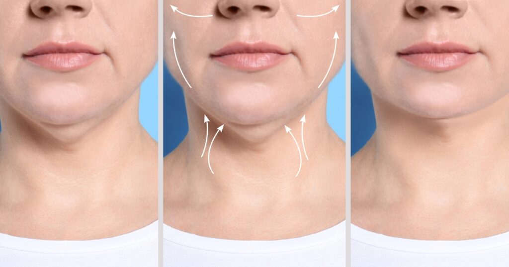 What Results Can I Expect From Neck And Chin Liposuction In Dubai