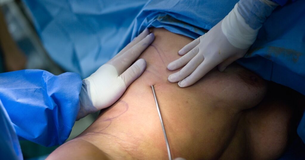 What Are The Best Areas To Target With Liposuction For A More Feminine Or Masculine Appearance