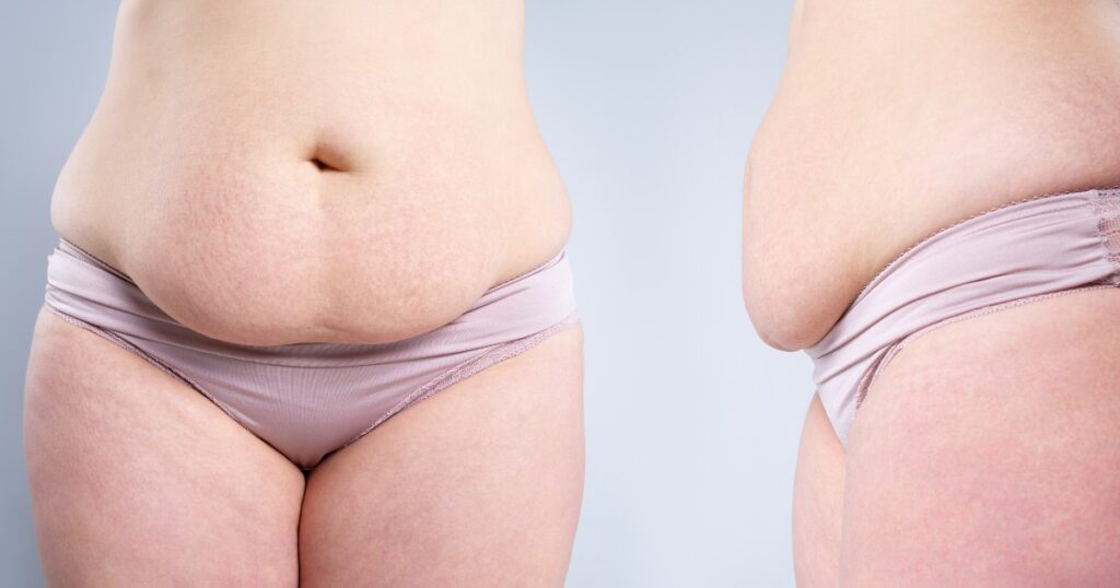 Can a tummy tuck go wrong