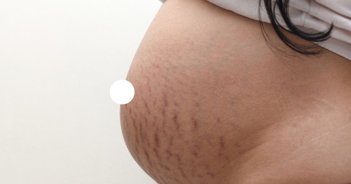 Does A Breast Lift Get Rid Of Stretch Marks