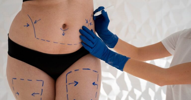 Liposuction For Obesity Treatment