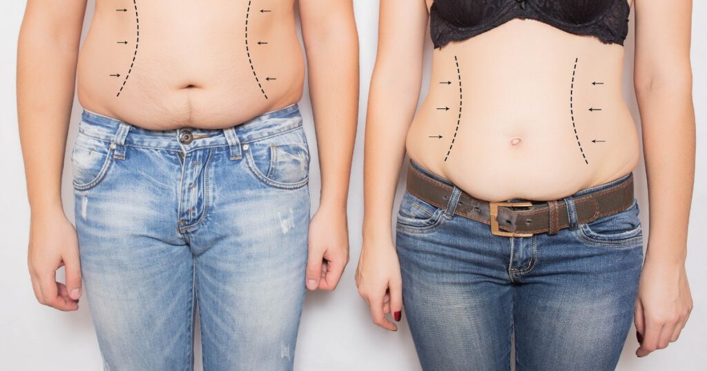 What Are The Risks Associated With Using Liposuction For Obesity