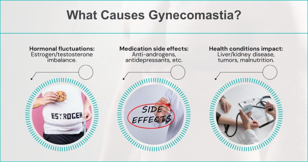 What Causes Gynecomastia