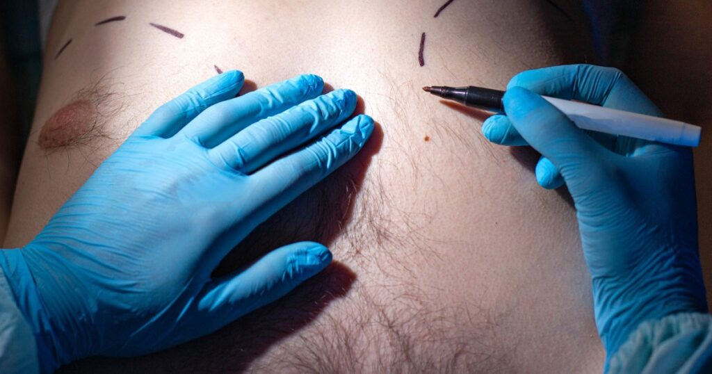 What surgical procedures treat gynecomastia type 1