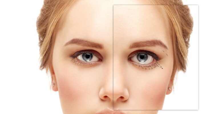 Blepharoplasty With Canthopexy