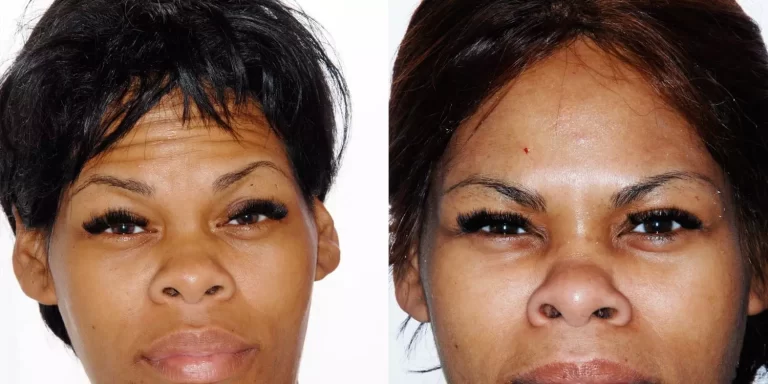 Botox What To Do Before And After
