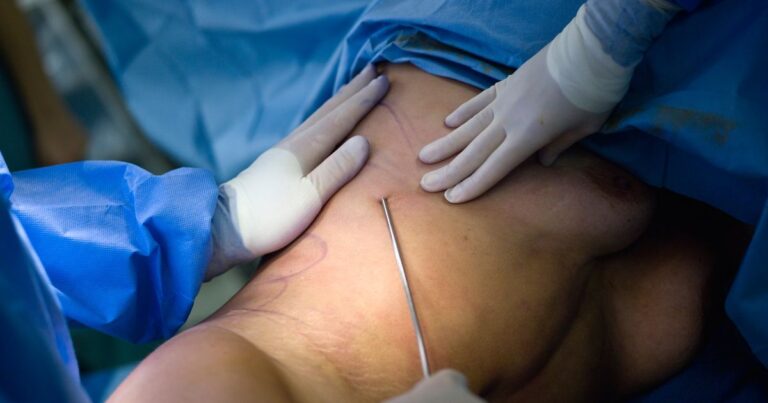 Can Liposuction Damage Your Organs? All You Need To Know
