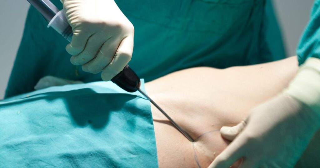 Can Liposuction Damage Organs_ – The Takeaway
