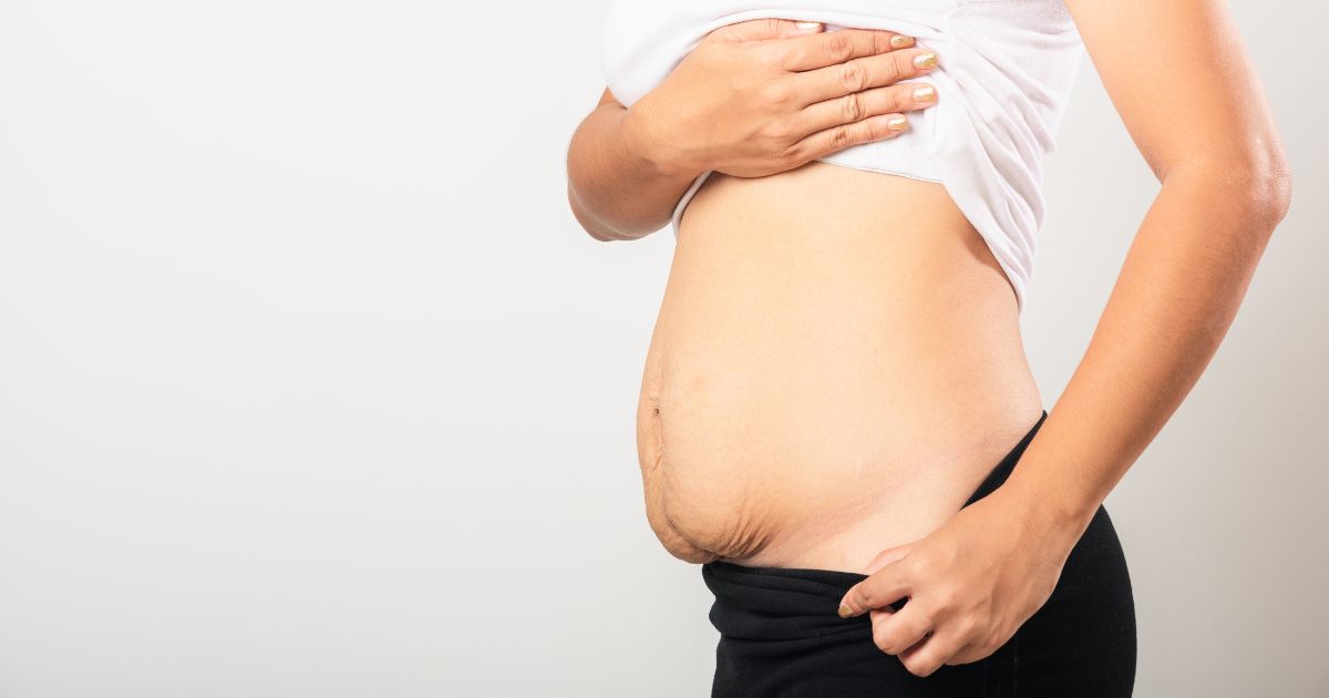 Does Liposuction Cause Loose Skin