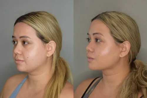 Double Chin Liposuction Swelling