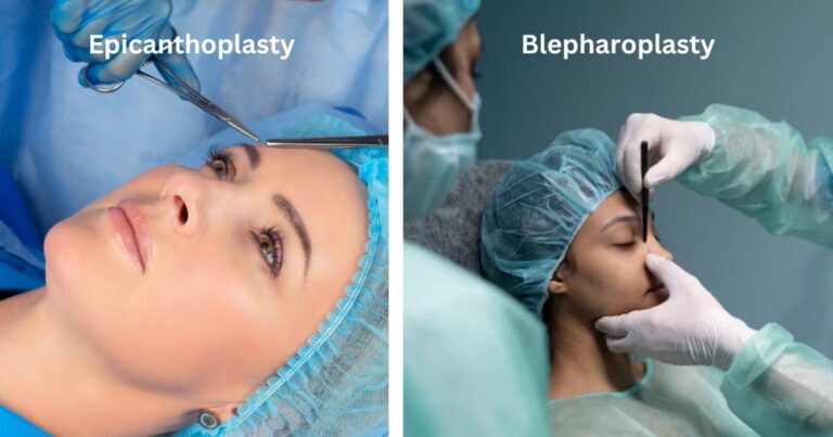 Epicanthoplasty And Blepharoplasty