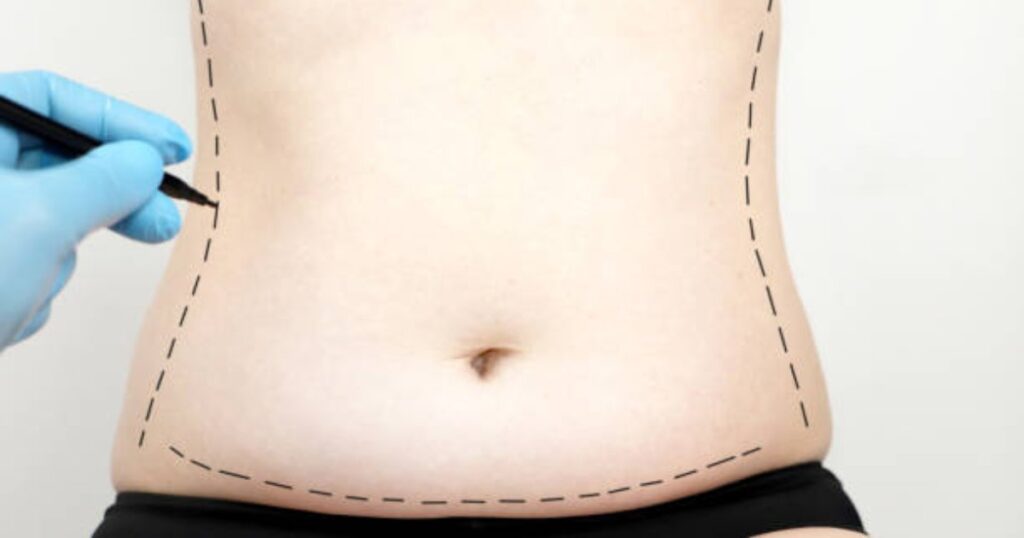 How Does Liposculpture Work