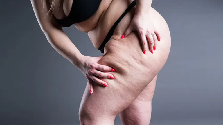 Lipedema And Liposuction: Choosing The Best Approach