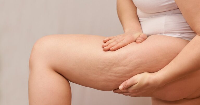 Liposculpture Scars: Appearance, Treatment And Healing Time